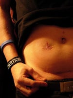 Scar fading gel HybriSil under fire from FDA