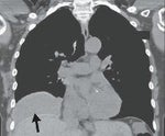 breast implant swallowed by body