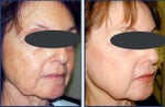 laser rejuvenation photos