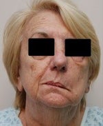 facial deformity depression