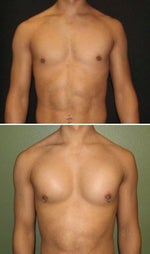 pec implants