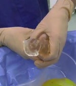 ruptured PIP Implant