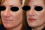 rhinoplasty makes you look younger