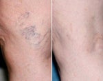 best vein treatment