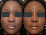 African American rhinoplasty