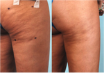 Cellulaze before and after. Photo credit Barry E. DiBernardo, MD