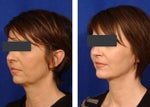 chin implant before and after