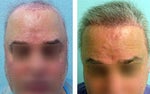 hair transplant before and after