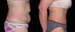 mommy makeover before and after