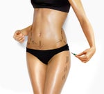 cellulaze coolsculpting