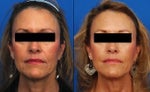 Ultherapy before and after