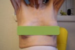 first breast implants