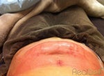 Coolsculpting by Zeltiq