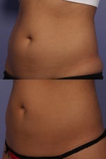 coolsculpting before and after