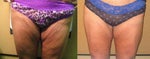 venus freeze before and after