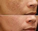 Skin resurfacing guide
