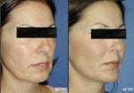 What Are My Options for Creating Fuller Cheeks?