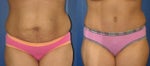 Tummy Tuck Before-After