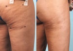 Cellulaze Before/After