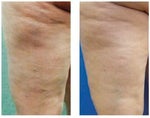 Cellulite