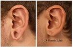 Earlobe Surgery