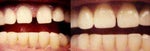 veneers