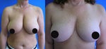 breast reduction