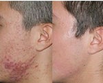 fraxel laser repair