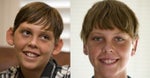 youth otoplasty
