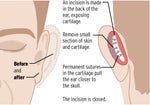 ear pinning