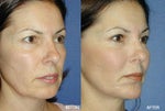 5 Reasons Some Patients Are Dropping Facelifts for a New Alternative