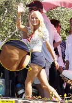 Fact or Fiction: Does Liposuction Cause Cellulite?