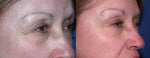 Botox