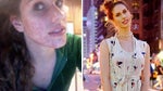 Acne-Plagued Teen Turned YouTube Sensation and Runway Model [VIDEO]