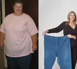 gastric before and after