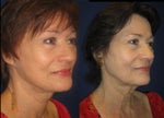 “What is the Difference Between a Lifestyle Lift and a Mini Lift?”