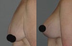 breast lift