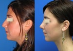 Five Pre-Procedure Rhinoplasty Questions To Ask