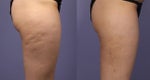 cellulaze before and after