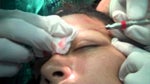 Eyebrow Transplant Surgery Can Deliver Natural Looking Results