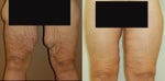 thigh lift