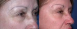 botox
