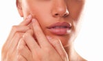 How To Get Rid Of Acne Scars