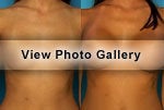 Breast Implants before and after photos