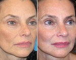 Cheek Augmentation before and after photos