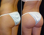 Brazilian Butt Lift before and after photos