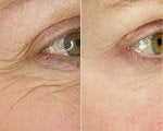 Wrinkle Treatment before and after photos