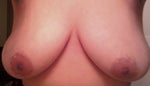 Really want to get a Breast reduction, Breast lift, then get Breast implants