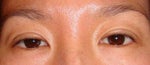 asymmetrical eyelids after 8 weeks of upper Blepharoplasty asymmetrical eyelids after 8 weeks of upper Blepharoplasty
