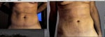before and after lipo